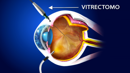 7.-Retinopatia-diabetica-proliferante_1-768×428